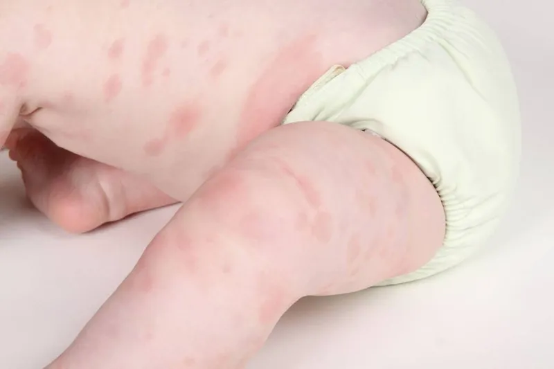 Trẻ sơ sinh bị dị ứng: nguyên nhân, triệu chứng và cách điều trị