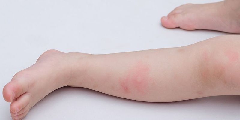 Trẻ sơ sinh bị kiến cắn: nguy hiểm không chỉ cho da bé