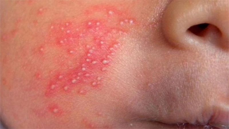 Mụn sữa ở trẻ sơ sinh và cách điều trị