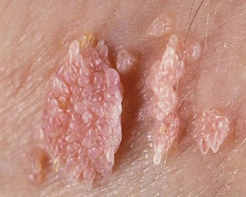 Mẹ bị sùi mào gà có cho con bú được không?