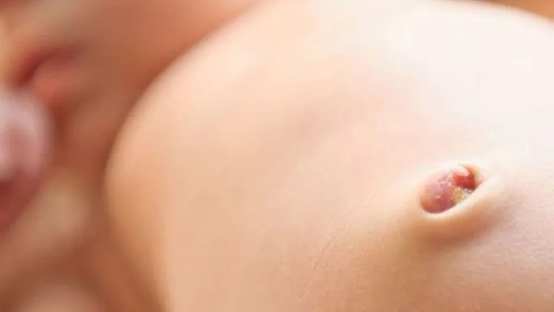 Có nên đeo băng rốn cho trẻ sơ sinh không?