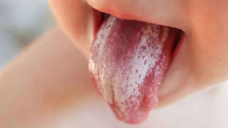 Nấm miệng dưới lưỡi ở trẻ em: triệu chứng, nguyên nhân và cách chẩn đoán