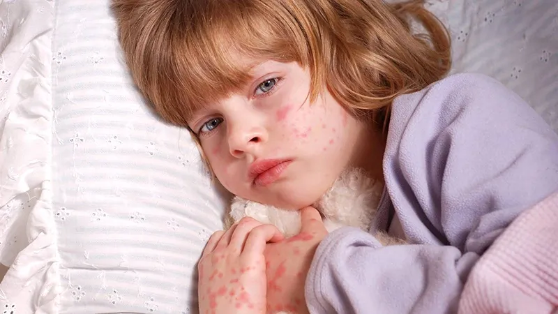 Bé bị nổi mẩn đỏ quanh mắt: nguyên nhân và điều trị hiệu quả