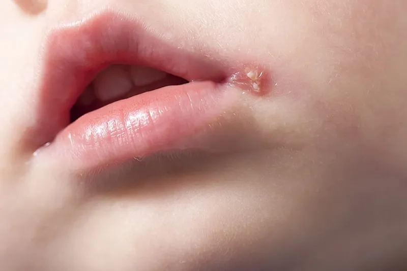 Herpes môi: bệnh do virus hsv, triệu chứng và phác đồ điều trị