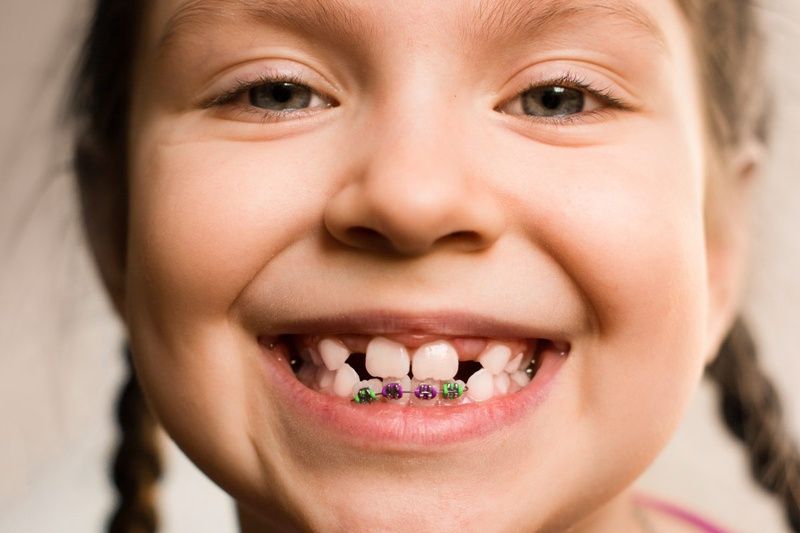 Niềng răng trẻ em: lợi ích và lưu ý cần biết