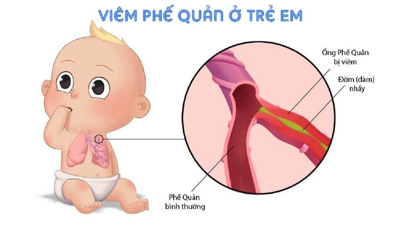 Phác đồ điều trị viêm phế quản ở trẻ em để giảm triệu chứng