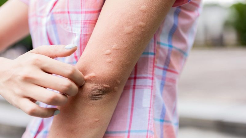 Dấu hiệu và cách chữa trị mề đay cấp tính