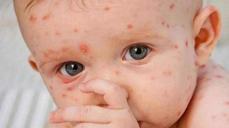 Trẻ phát ban đỏ sau 3 ngày sốt: nguyên nhân, bệnh lý và cách chăm sóc