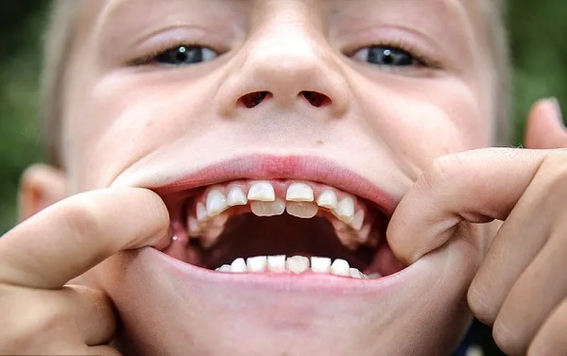 Trẻ mấy tuổi thì thay răng sữa? giải đáp thắc mắc