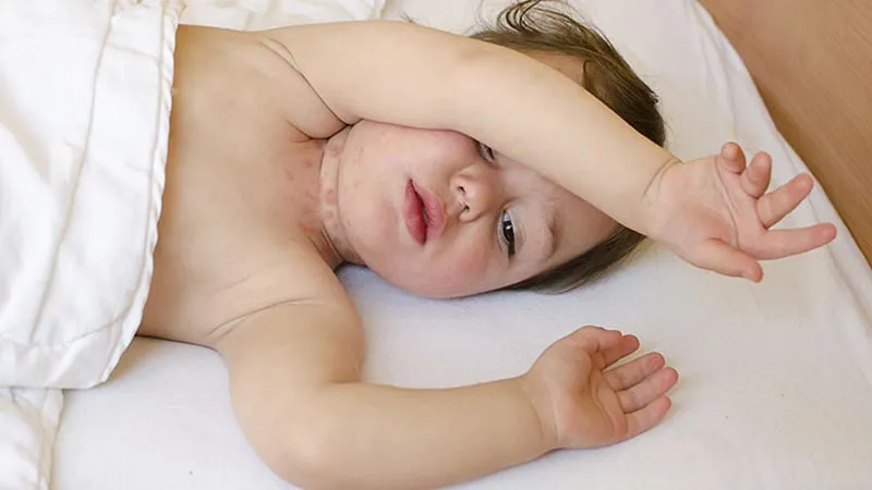 Tìm hiểu về hăm cổ và cách bôi thuốc phù hợp cho trẻ