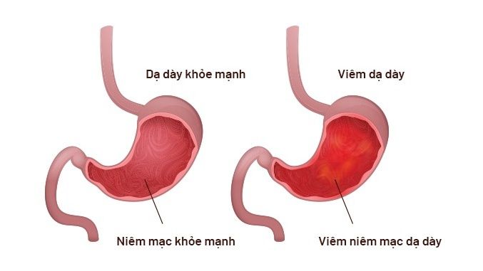 Phác đồ điều trị viêm dạ dày: hiểu về bệnh và cách điều trị