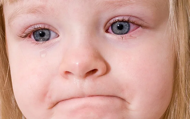 Bệnh đau mắt đỏ ở trẻ em: điều trị và vệ sinh mắt cho bé