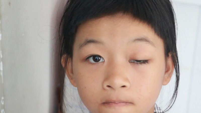 Loạn sắc tố mống mắt - đặc điểm và nguyên nhân gây ra