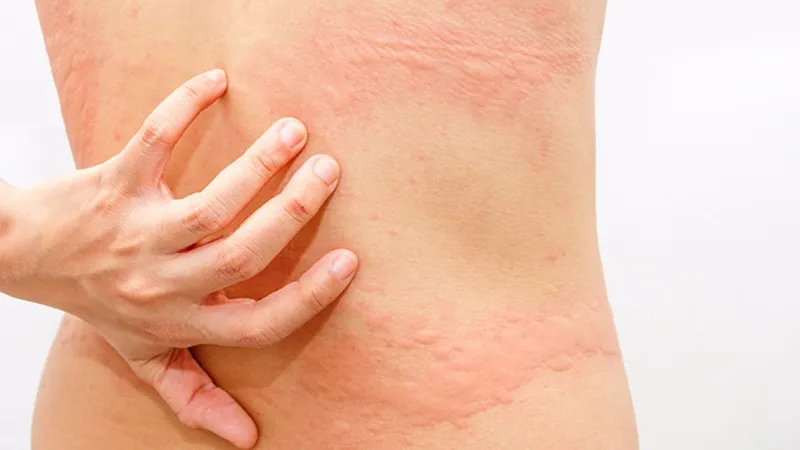 Dấu hiệu và cách chữa trị mề đay cấp tính