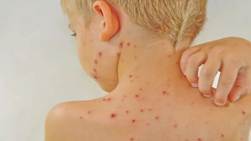 Tìm hiểu về phương pháp dân gian chữa sốt phát ban an toàn cho trẻ