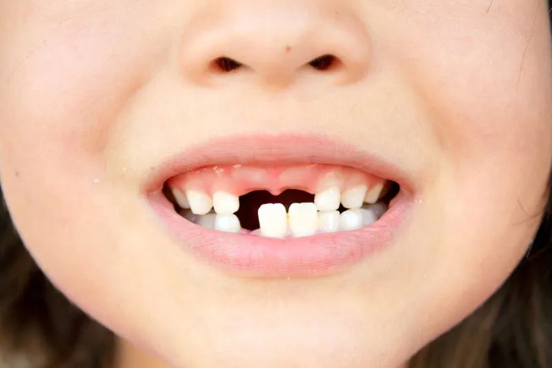 Răng sữa trẻ em có thay hết không? tìm hiểu về quá trình mọc và thay răng