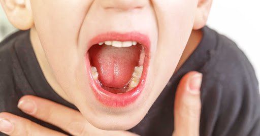 Phẫu thuật nội soi nạo VA bằng dao plasma ở trẻ em | Vinmec
