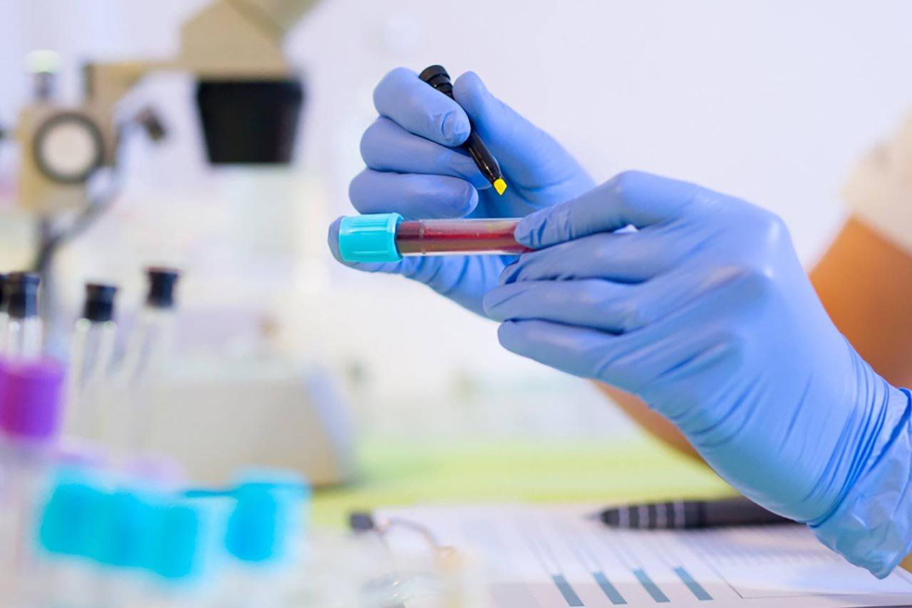 Xét nghiệm anti HCV là xét nghiệm gì? | Vinmec