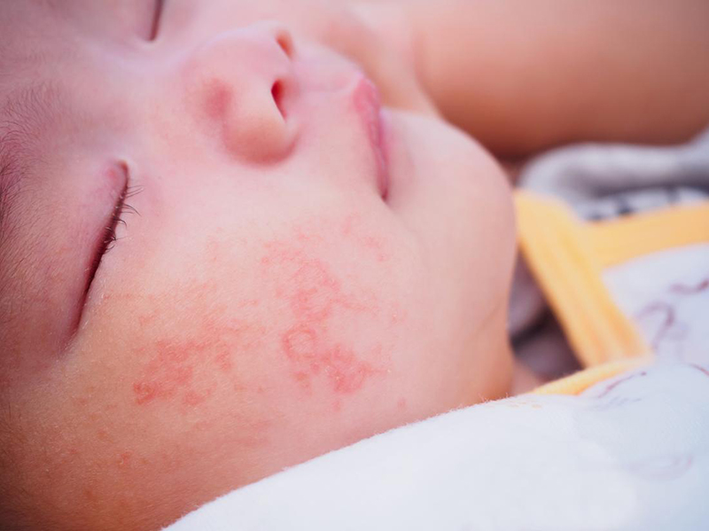 Dị ứng thức ăn ở trẻ - những điều cha mẹ cần biết | Medlatec