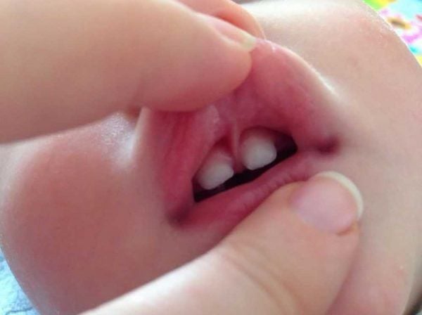 Biện pháp cải thiện tình trạng phanh môi bám thấp ở trẻ? | Vinmec