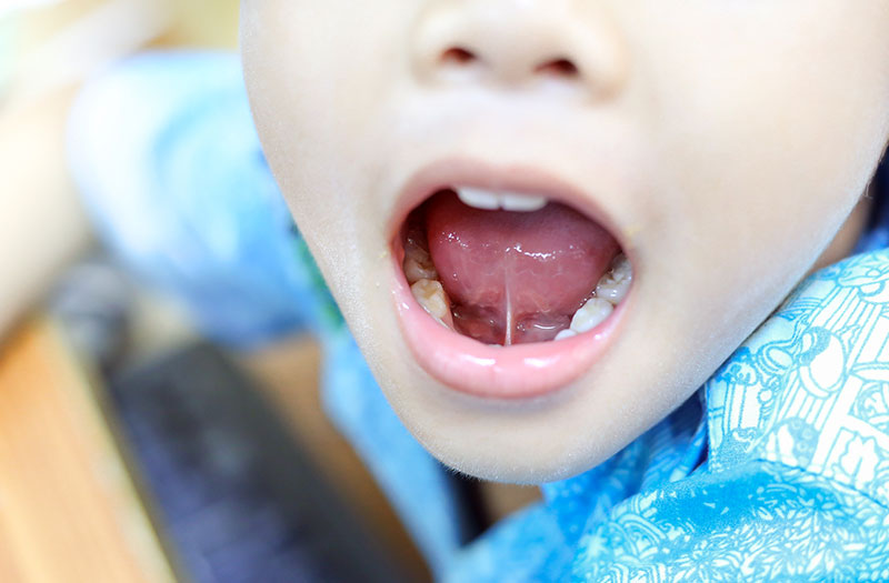 Dính thắng lưỡi ở trẻ: Nguyên nhân, biểu hiện và phương pháp xử lý