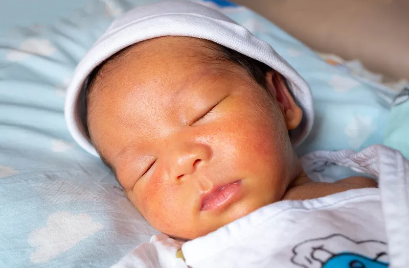 Vàng lưỡi: nguyên nhân, triệu chứng và cách điều trị
