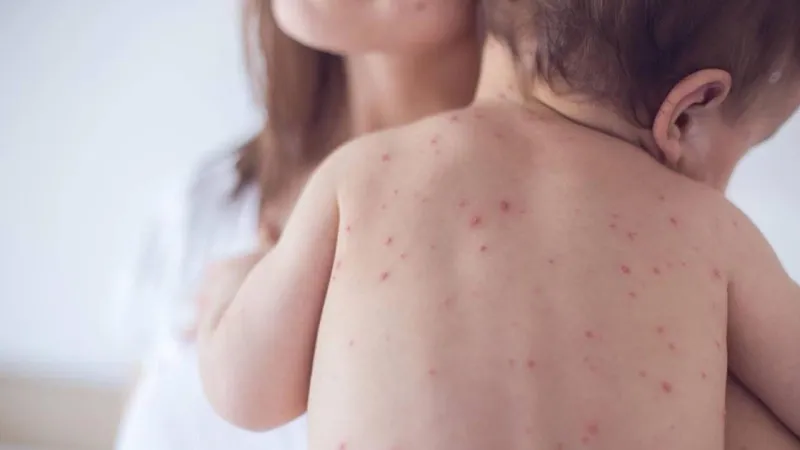 Sốt phát ban: tắm lá gì cho trẻ nhanh hết bệnh?
