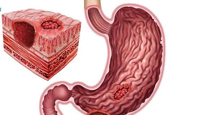 Phác đồ điều trị viêm dạ dày: hiểu về bệnh và cách điều trị