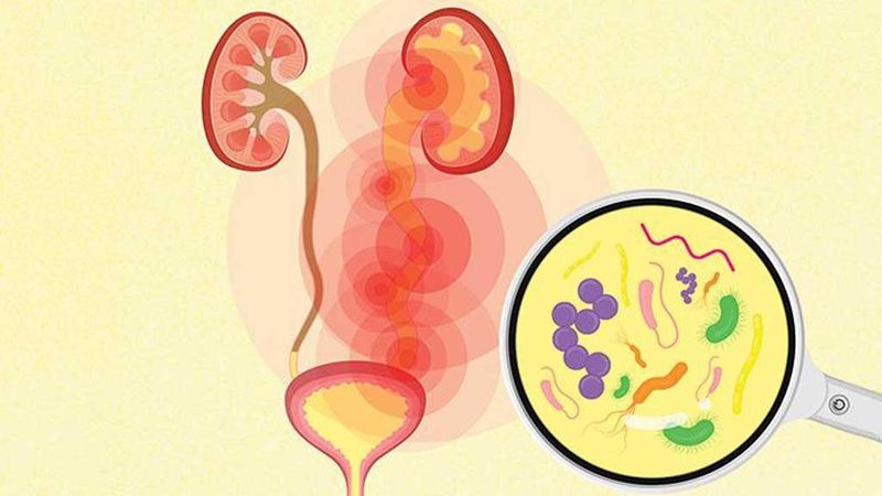 Sỏi thận 12mm có phải mổ không? tìm hiểu phương pháp tán sỏi ngoài cơ thể