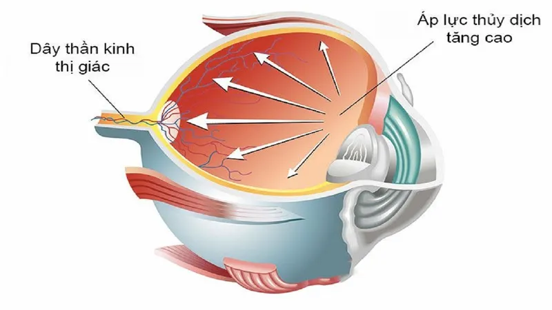 Tăng huyết áp mắt: nguyên nhân, chẩn đoán và điều trị