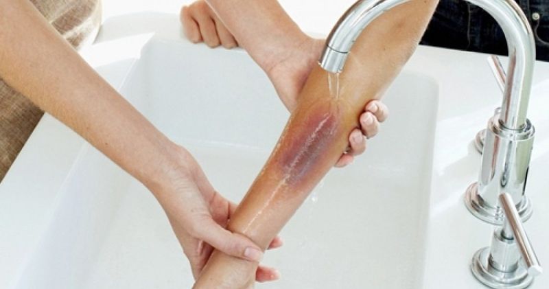 Sơ cứu bị bỏng và tầm quan trọng của việc đảm bảo sự phục hồi hoàn toàn
