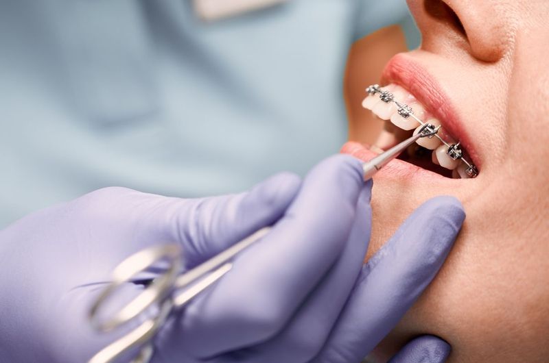 Tuổi 25 có thể niềng răng được không?