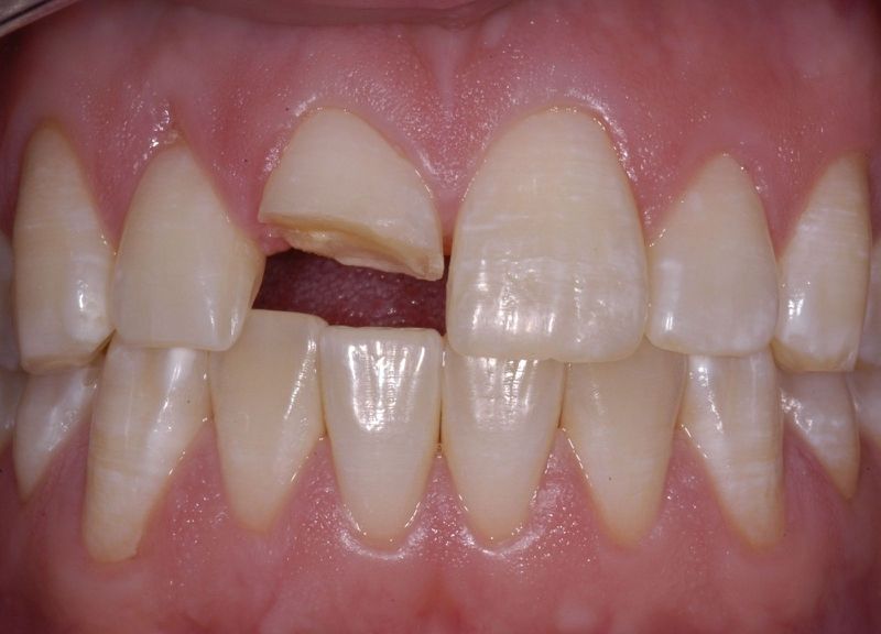 Trám răng sâu - phương pháp hiệu quả để bảo vệ răng miệng