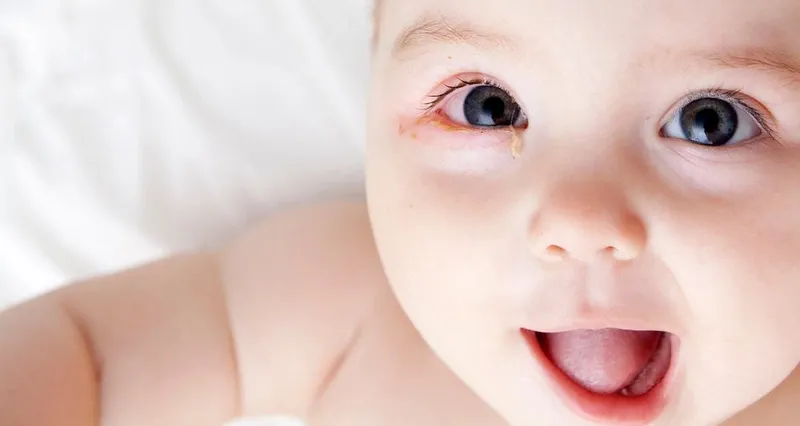 Bệnh mắt đổ ghèn xanh ở trẻ sơ sinh: nguyên nhân và cách điều trị