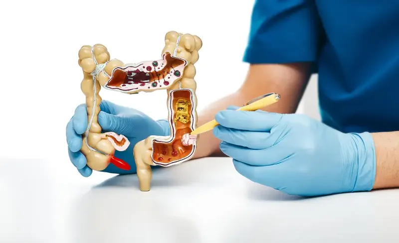 Viêm trực tràng: nguyên nhân, triệu chứng và phương pháp điều trị