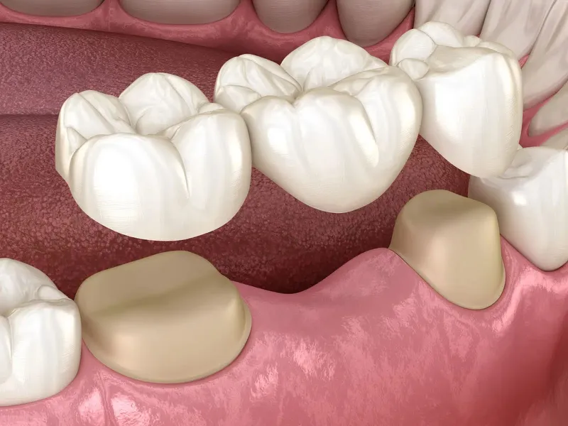 Cầu răng sứ - phương pháp phổ biến và phù hợp trong nha khoa thẩm mỹ