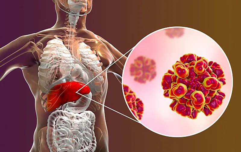 Viêm gan c và xét nghiệm anti hcv: tìm hiểu về bệnh và phương pháp xét nghiệm