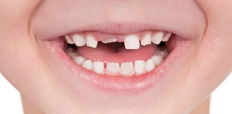 Răng mọc chồi: tình trạng, tác động và cách khắc phục