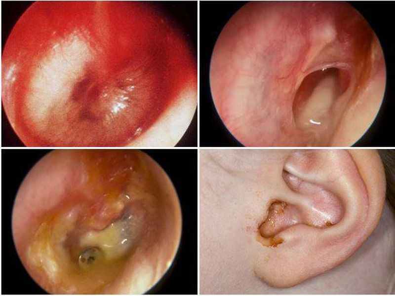 Thủng màng nhĩ ở trẻ: nguyên nhân, triệu chứng và cách điều trị