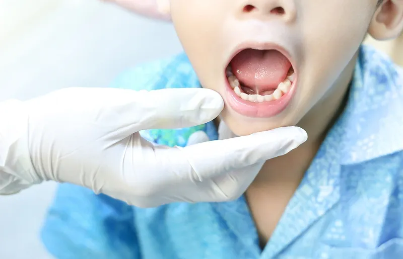 Dính thắng lưỡi ở trẻ: vấn đề và cách giải quyết