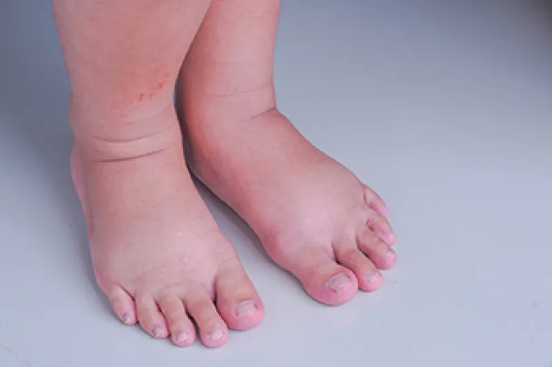 Phù phổi: nguyên nhân, triệu chứng và cách điều trị