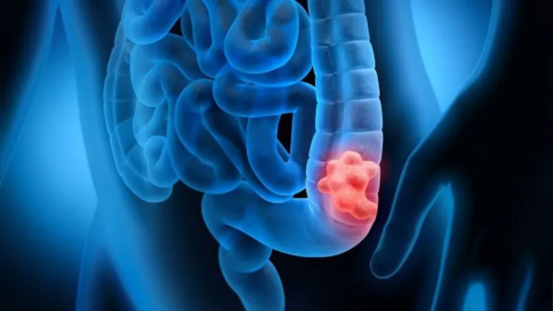 Polyp loạn sản đại tràng: nguyên nhân và cách điều trị