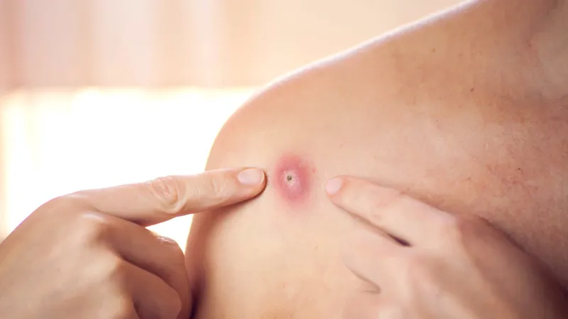 Nhiễm khuẩn tụ cầu vàng: nguyên nhân, triệu chứng và cách phòng ngừa