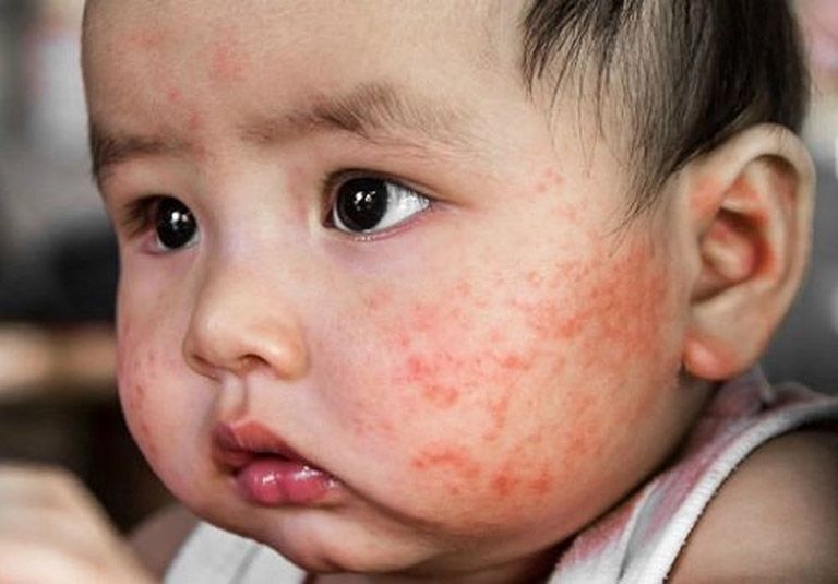 Mụn sữa ở trẻ sơ sinh và cách điều trị