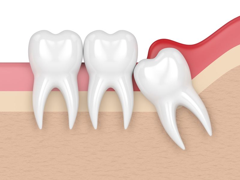 Răng khôn: cách chăm sóc và xử trí khi mọc răng khôn