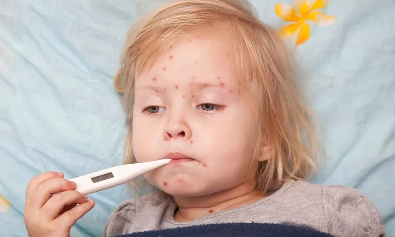 Chữa bệnh zona ở trẻ em tại nhà để hạn chế cảm giác đau đớn
