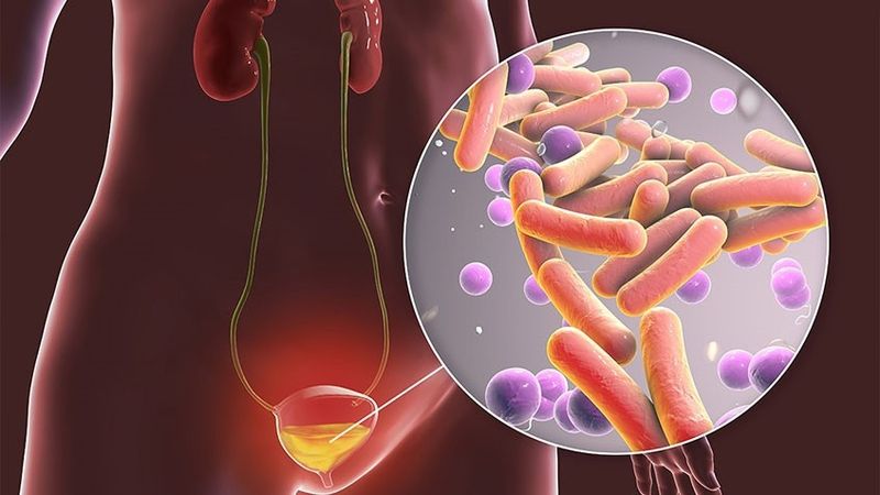 Nhiễm trùng đường tiểu (urosepsis): nguyên nhân, triệu chứng và cách điều trị