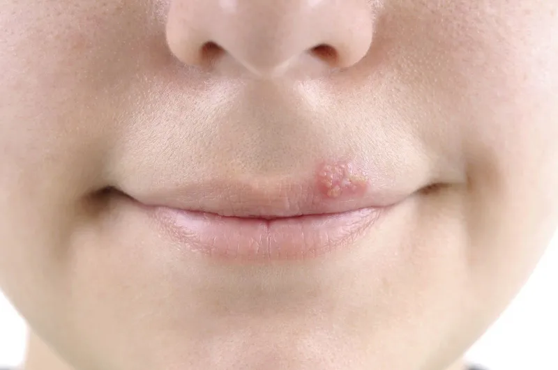 Phân biệt vết loét lạnh và mụn: những điểm khác biệt quan trọng