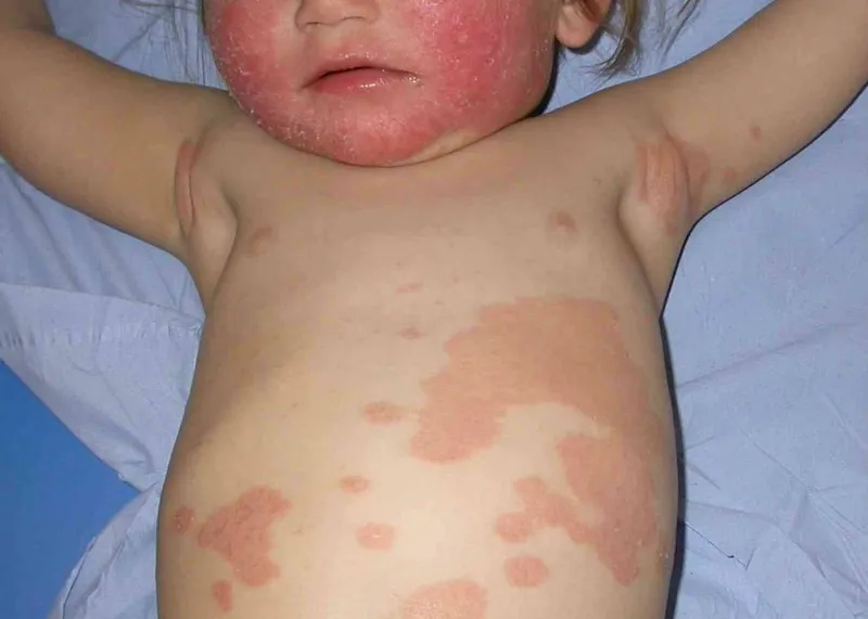 Bệnh vẩy nến ở trẻ sơ sinh: tổn thương da và cách chăm sóc đúng cách