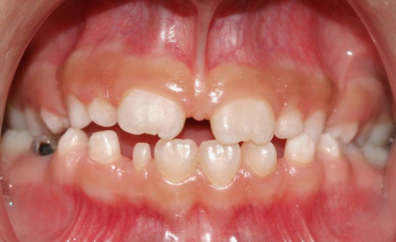 Tình trạng răng nhỏ: kiến thức cần biết